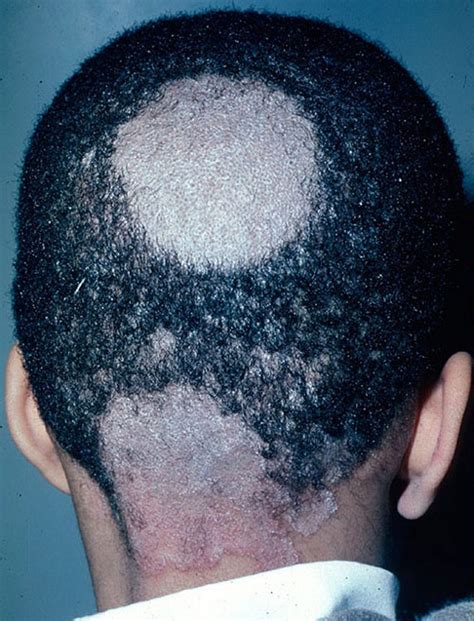 Dermatofitosi del cuoio capelluto (tinea capitis).